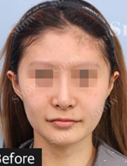 韩国snow面部吸脂解决双下巴问题！童颜感案例即刻分享！
