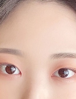 韩国yellow整形眼综合分享：双眼皮+开眼角+去眼内脂肪三合一！