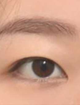 韩鼓icon整形埋线双眼皮手术图