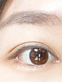 韩鼓icon整形埋线双眼皮手术图