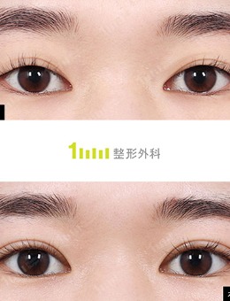 韩国1mm整形修复双眼皮痕迹过浅照片