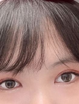 韩国yellow双眼皮+开眼角+眼提肌综合施术对比案例