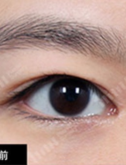 韩国1mm整形外科自然粘连修复双眼皮案例图