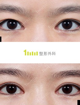 韩国1mm整形外科自然粘连修复双眼皮日记图