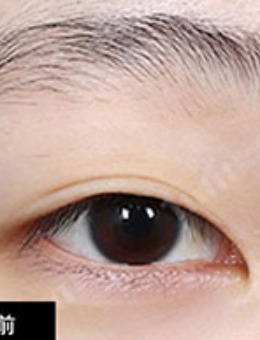 韩国1mm整形窄款双眼皮加宽加深对比照