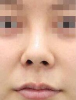韩国note整形鼻修复手术对比照_术前