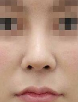 韩国note整形鼻修复手术对比照_术后