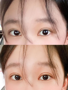 韩国yellow整形双眼皮+开眼角手术图片