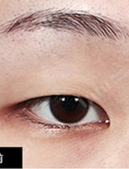 韩国1mm整形自然粘连法双眼皮对比照_术前