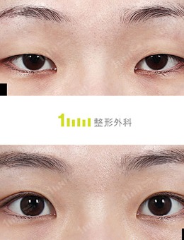 韩国1mm整形自然粘连法双眼皮对比照_术后