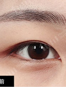 韩国1毫米整形双眼皮手术对比照