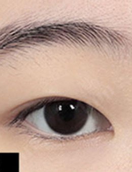 韩国1mm整形自然粘连法双眼皮+开眼角对比照