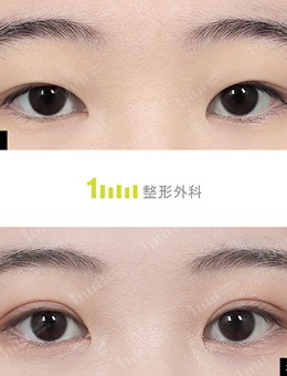 韩国1mm整形自然粘连法双眼皮+开眼角对比照_术后