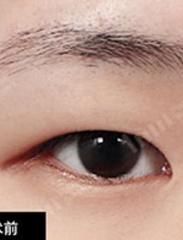 韩国1mm整形双眼皮手术对比案例_术前