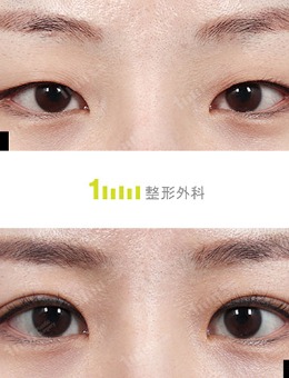 韩国1mm整形双眼皮+开眼角恢复对比图