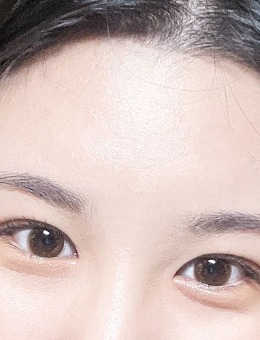 -韩国yellow整形双眼皮开上眼角手术对比照