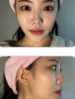 -韩国爱乐整形精致韩系隆鼻手术对比照