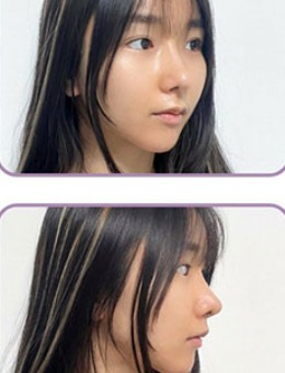 韩国爱乐整形鼻头鼻尖塑形对比照