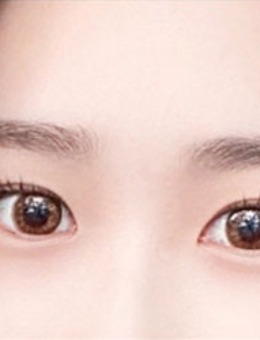 韩国yellow埋线双眼皮+开眼角手术对比照_术前
