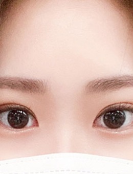 韩国yellow埋线双眼皮+开眼角手术对比照_术后