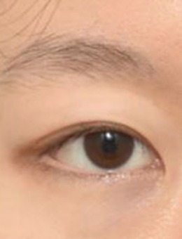 韩国icon整形埋线修复双眼皮手术图_术前