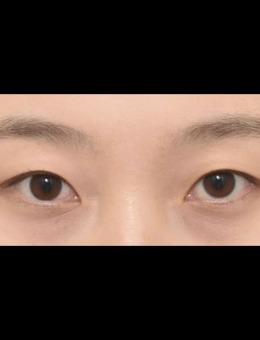 韩国icon整形双眼皮+眼底脂肪再排列(去眼袋)手术案例_术前