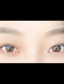 -韩国icon整形双眼皮+眼底脂肪再排列(去眼袋)手术案例