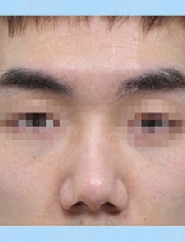 韩国CHOI开放式鼻尖手术对比照_术前