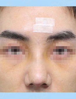 韩国CHOI开放式鼻尖手术对比照_术后