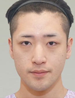韩国BornDi整形男士隆鼻+轮廓手术3个月对比案例
