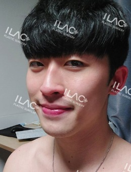 韩国爱乐整形男士隆鼻手术对比照片