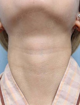 韩国CHOI整形玻尿酸去颈纹效果 用图片告诉你好不好！_术前