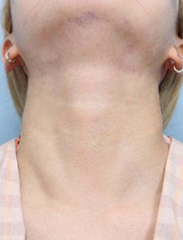 韩国CHOI整形玻尿酸去颈纹效果 用图片告诉你好不好！_术后