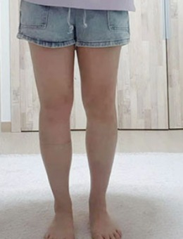 韩国wiz美迷你吸脂针，超强力瘦腿对比照片分享！