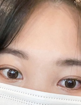 -韩国yellow埋线双眼皮术后恢复60天对比照