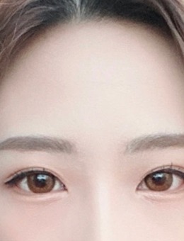 -韩国yellow双眼皮线条改善对比照片