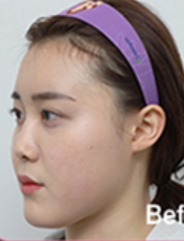 韩国爱她整形S型小翘鼻手术对比照