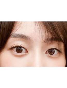 -韩国yellow埋线眼提肌+脂肪移植填充眼窝凹陷对比照
