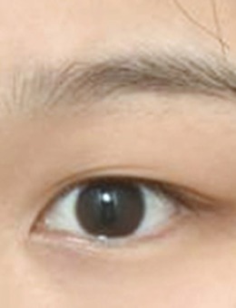 -韩国icon双眼皮成形术+开眼角直观对比照