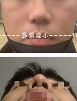 -韩国Ucanb男士鼻翼缩小手术对比照