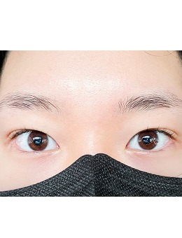 -韩国yellow整形埋线双眼皮手术对比照
