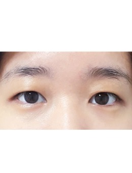 韩国yellow整形埋线双眼皮手术重塑“桃花眼”_术前