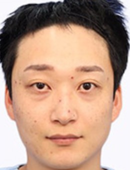韩国林克整形男士眼提肌+隆鼻+皮肤管理手术对比照_术前