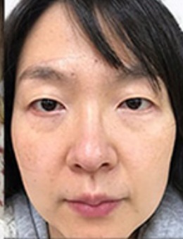 韩国林克整形减龄手术：眼底脂肪重排+线雕+眼形矫正对比案例_术前