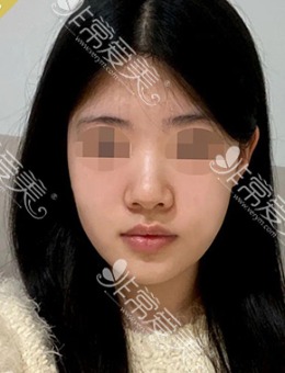 -自体肋骨初鼻“超凡脱俗仙女范”整形案例​，由韩国优雅人整形提供！