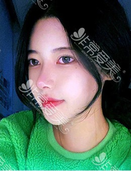 -自体肋骨初鼻“超凡脱俗仙女范”整形案例​，由韩国优雅人整形提供！