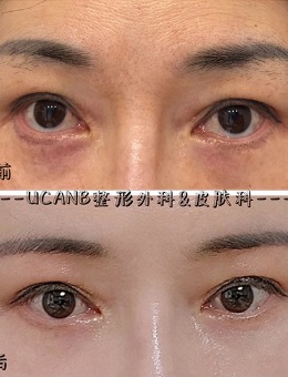 -韩国Ucanb整形女士切眉手术+后眼角下至+眼底脂肪再配置对比照片