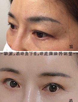韩国Ucanb整形女士切眉手术+后眼角下至+眼底脂肪再配置对比照片