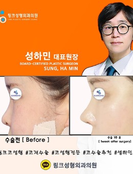 韩国林克整形鼻修复（异体骨）手术对比照_术后