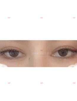 睁眼无力眼修复手术对比照，图片来源韩国现代美学整形！_术前